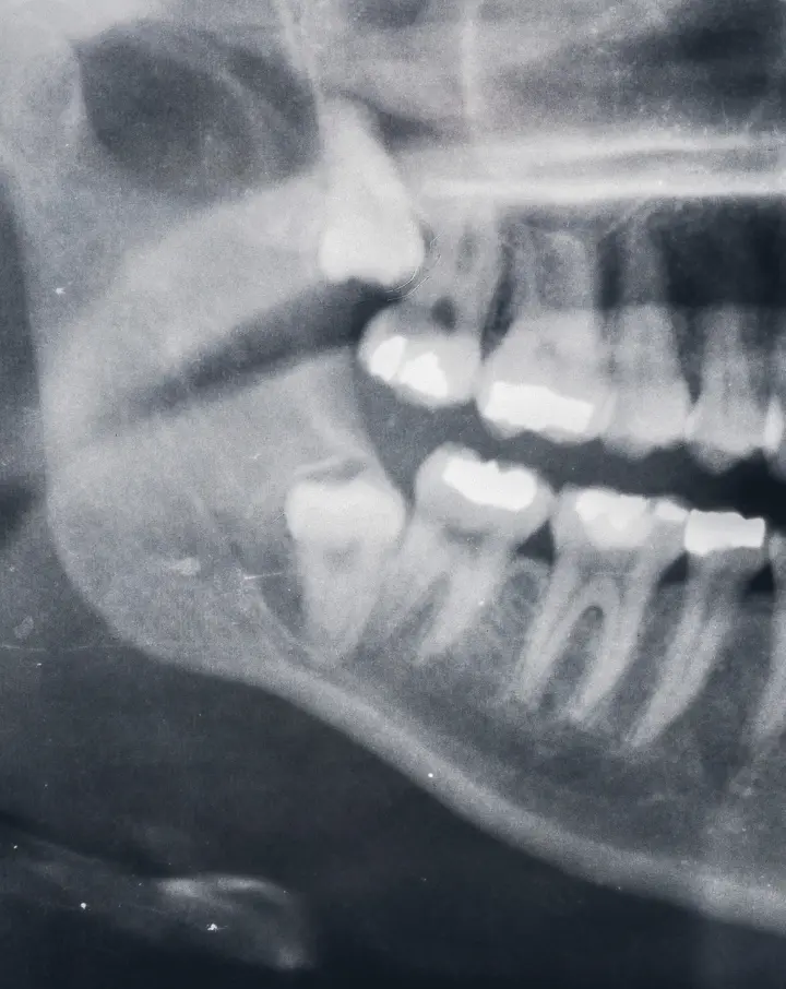 Wisdom tooth at holly dental associates sign in centennial co