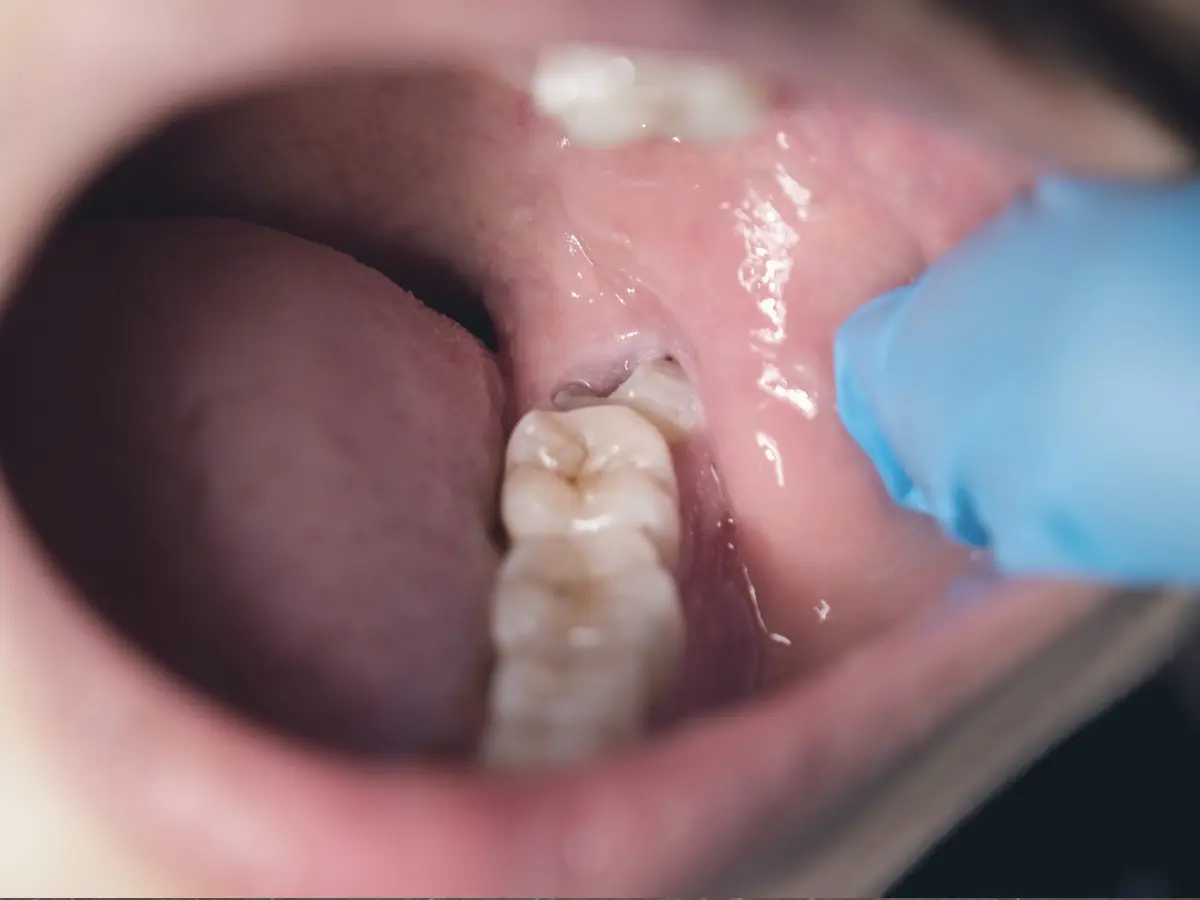 extractions and wisdom teeth removal at holly dental associates in centennial, co